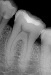 Рентген зубов